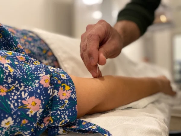 Acupuncture